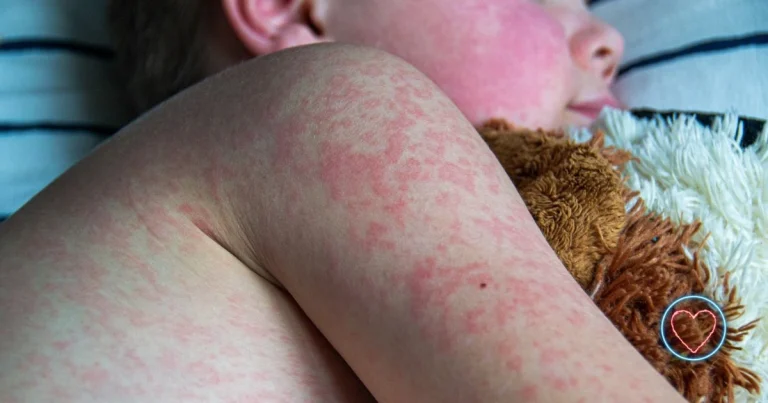 The 2025 U.S. Measles Outbreak: A Public Health Crisis Reemerges