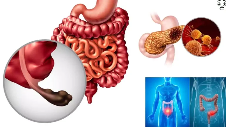 Bowl Cancer and Everything You Need to Know Causes, Prevention, and Key Facts